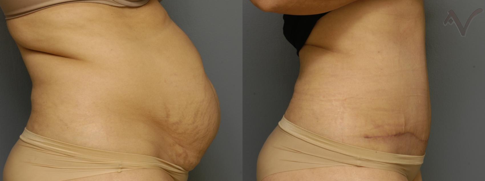 Before & After Tummy Tuck Case 462 Right Side View in Los Angeles, CA