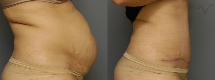 Before & After Tummy Tuck Case 462 Right Side View in Los Angeles, CA
