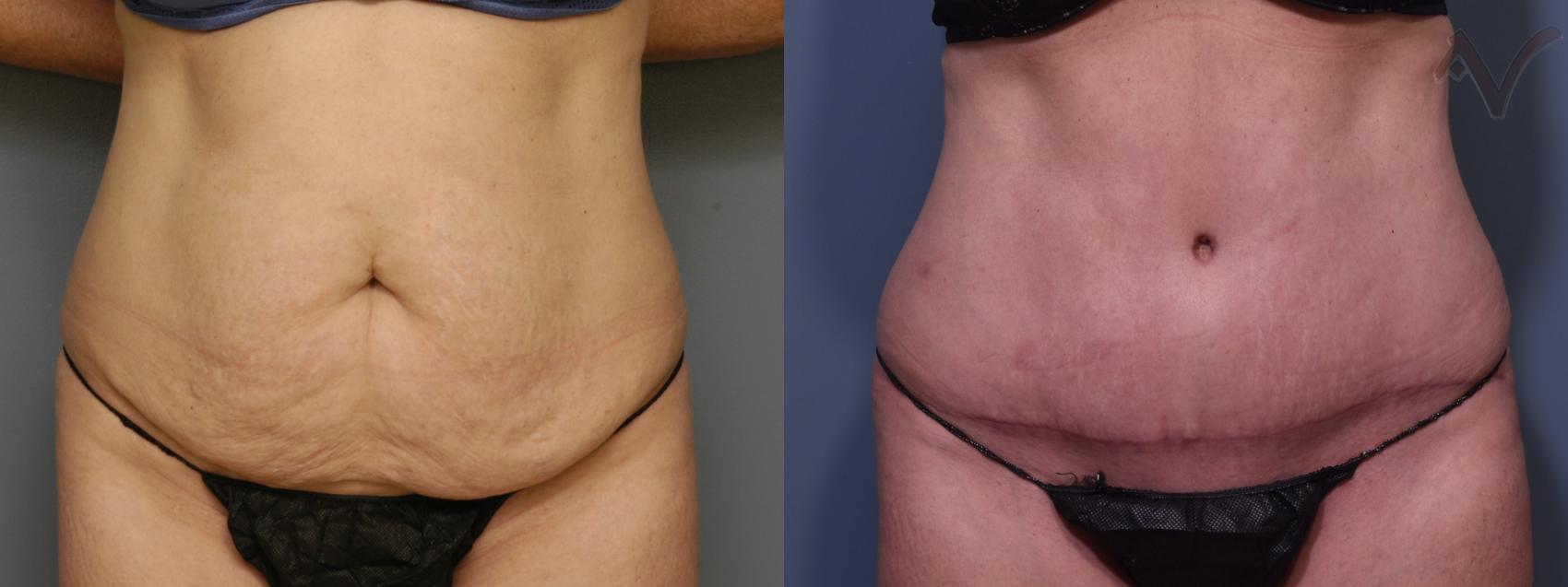 Before & After Tummy Tuck Case 463 Front View in Los Angeles, CA