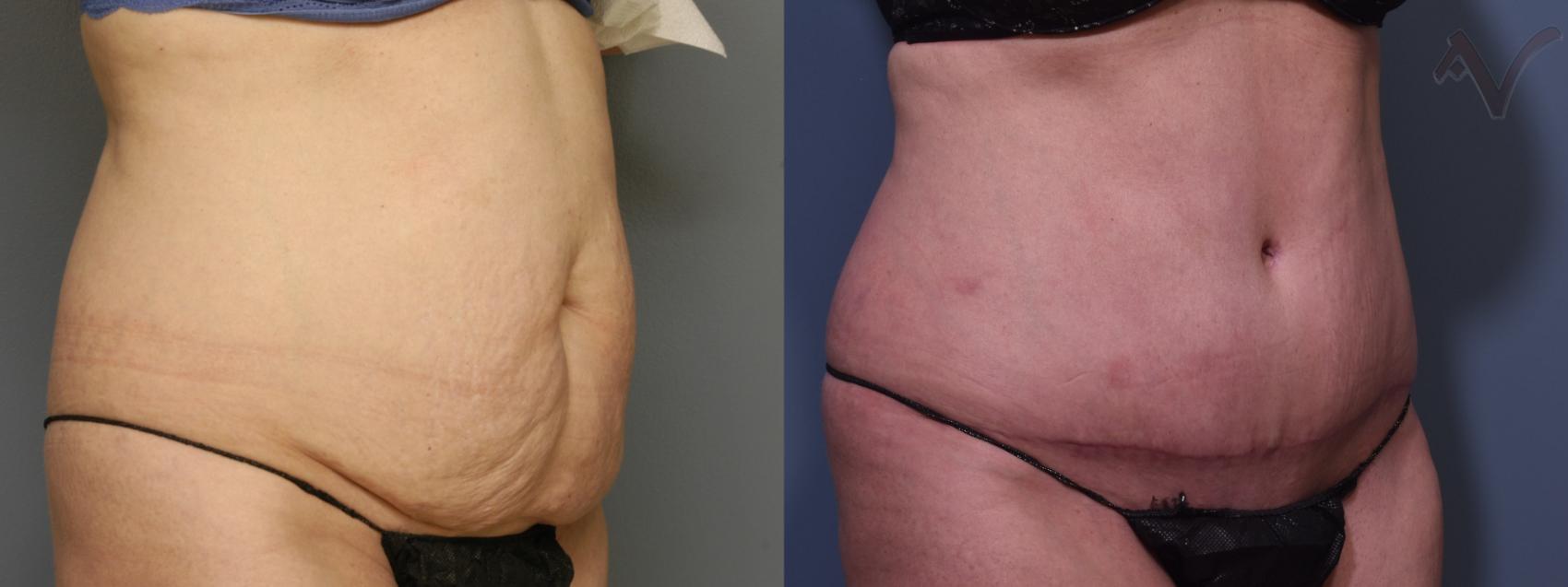 Before & After Tummy Tuck Case 463 Right Oblique View in Los Angeles, CA