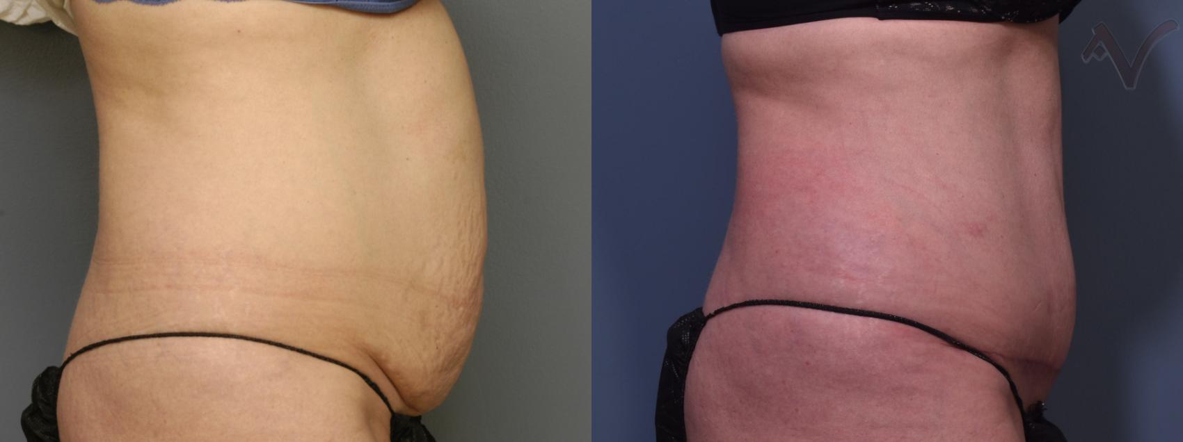 Before & After Tummy Tuck Case 463 Right Side View in Los Angeles, CA