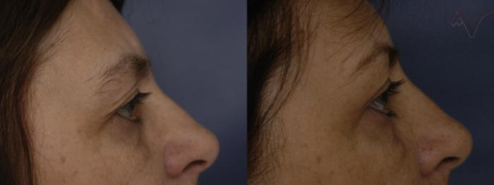 Before & After Upper Eyelid Surgery Case 243 Right Side View in Los Angeles, CA