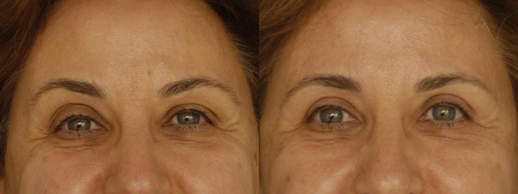 Before & After Upper Eyelid Surgery Case 244 Front View in Los Angeles, CA