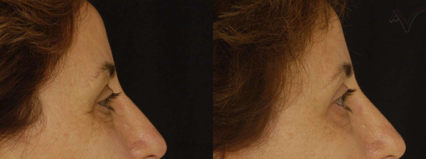 Before & After Upper Eyelid Surgery Case 244 Right Side View in Los Angeles, CA