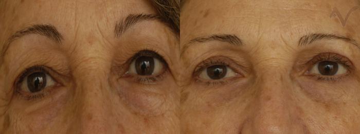 Before & After Upper Eyelid Surgery Case 246 Front View in Los Angeles, CA