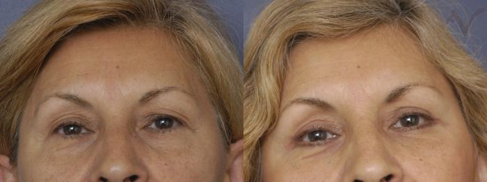 Before & After Upper Eyelid Surgery Case 248 Front View in Los Angeles, CA