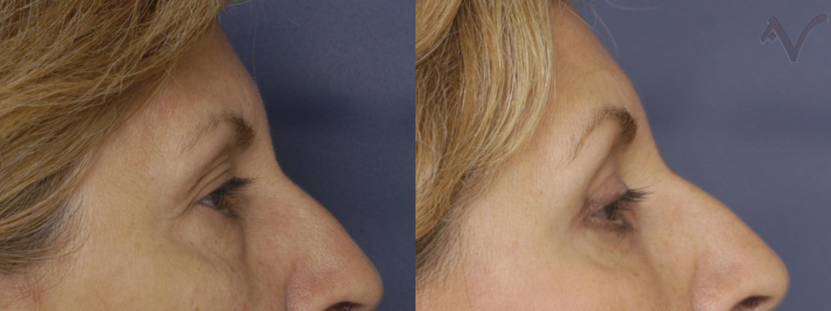 Before & After Upper Eyelid Surgery Case 248 Right Side View in Los Angeles, CA