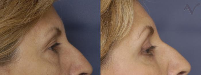 Before & After Upper Eyelid Surgery Case 248 Right Side View in Los Angeles, CA