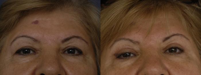 Before & After Upper Eyelid Surgery Case 253 Front View in Los Angeles, CA