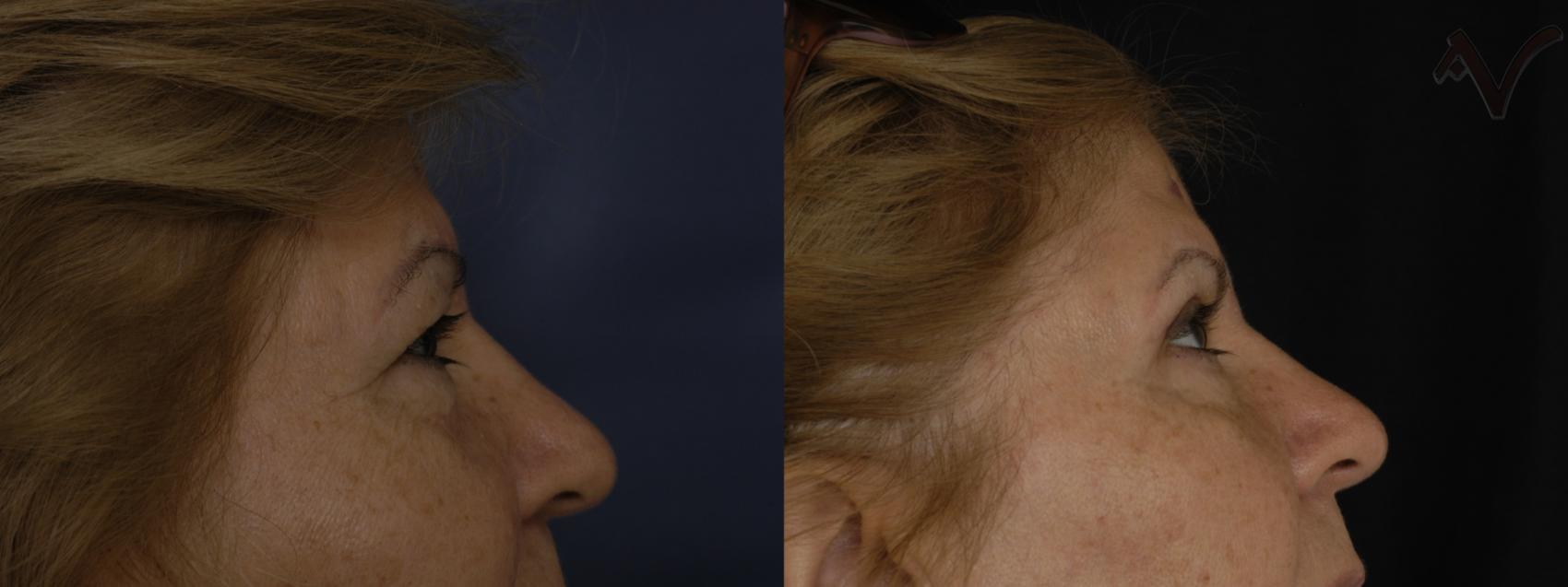 Before & After Upper Eyelid Surgery Case 253 Right Side View in Los Angeles, CA