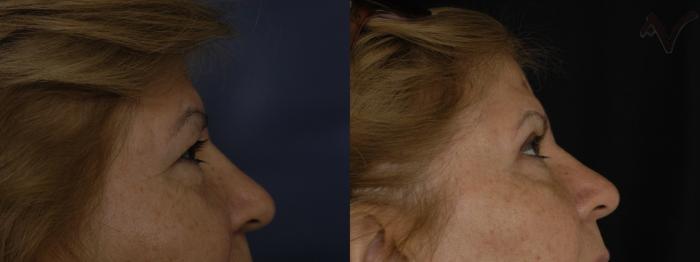 Before & After Upper Eyelid Surgery Case 253 Right Side View in Los Angeles, CA