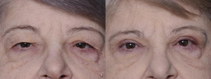 Before & After Upper Eyelid Surgery Case 269 Front View in Los Angeles, CA
