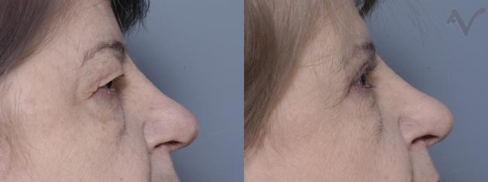Before & After Upper Eyelid Surgery Case 269 Right Side View in Los Angeles, CA