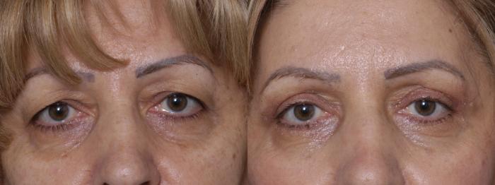 Before & After Upper Eyelid Surgery Case 272 Front View in Los Angeles, CA