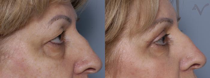 Before & After Upper Eyelid Surgery Case 272 Right Side View in Los Angeles, CA