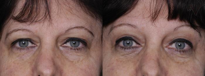 Before & After Upper Eyelid Surgery Case 275 Front View in Los Angeles, CA