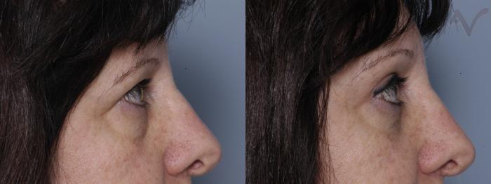 Before & After Upper Eyelid Surgery Case 275 Right Side View in Los Angeles, CA