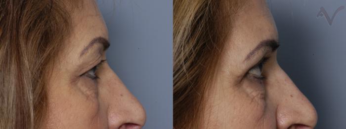 Before & After Upper Eyelid Surgery Case 276 Right Side View in Los Angeles, CA