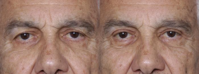 Before & After Upper Eyelid Surgery Case 277 Front View in Los Angeles, CA
