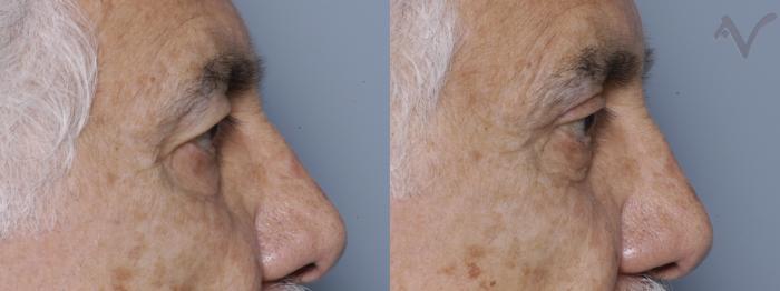 Before & After Upper Eyelid Surgery Case 277 Right Side View in Los Angeles, CA