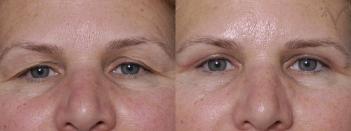 Before & After Upper Eyelid Surgery Case 306 Front View in Los Angeles, CA