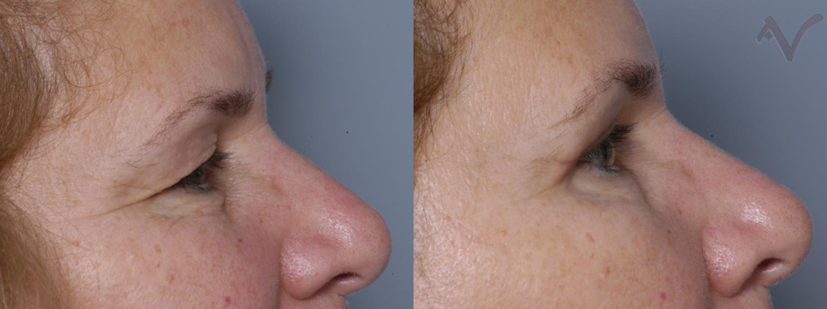 Before & After Upper Eyelid Surgery Case 306 Right Side View in Los Angeles, CA