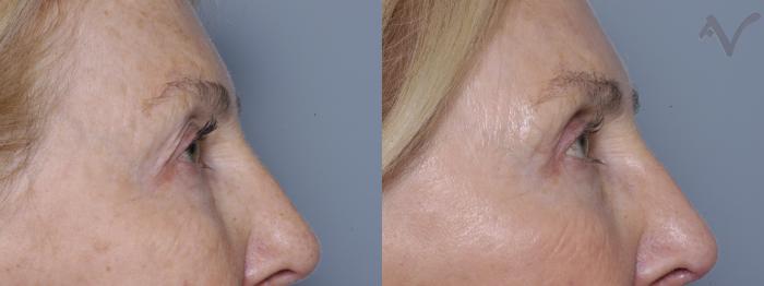Before & After Upper Eyelid Surgery Case 313 Right Side View in Los Angeles, CA