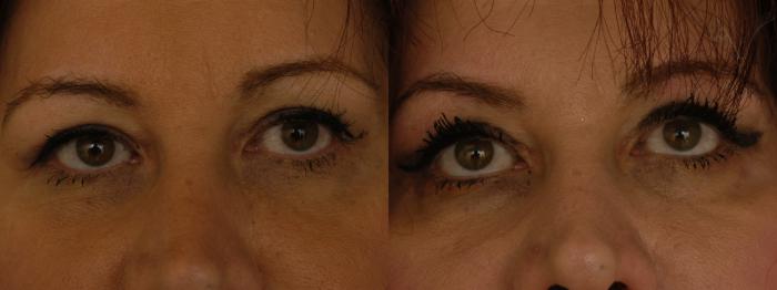 Before & After Upper Eyelid Surgery Case 315 Front View in Los Angeles, CA