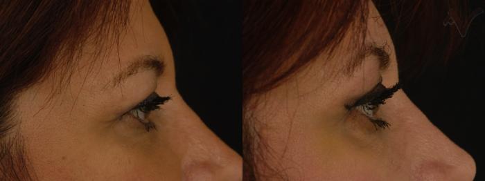 Before & After Upper Eyelid Surgery Case 315 Right Side View in Los Angeles, CA