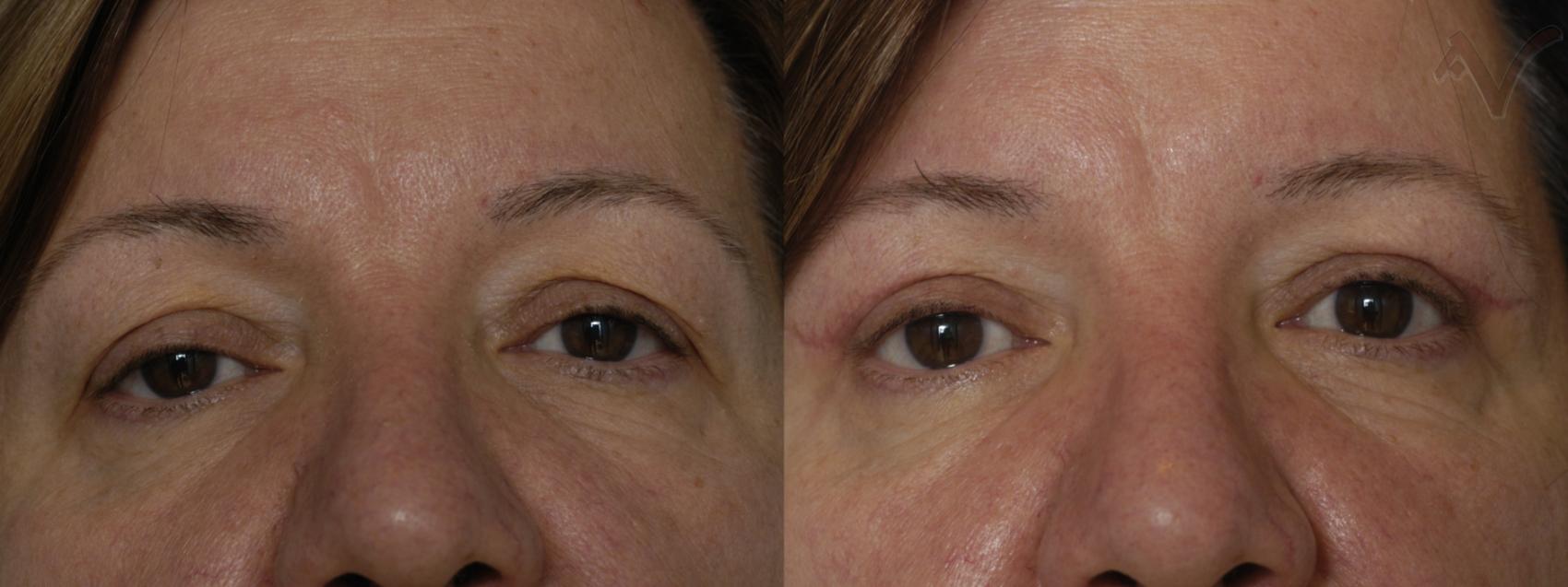 Before & After Upper Eyelid Surgery Case 316 Front View in Los Angeles, CA