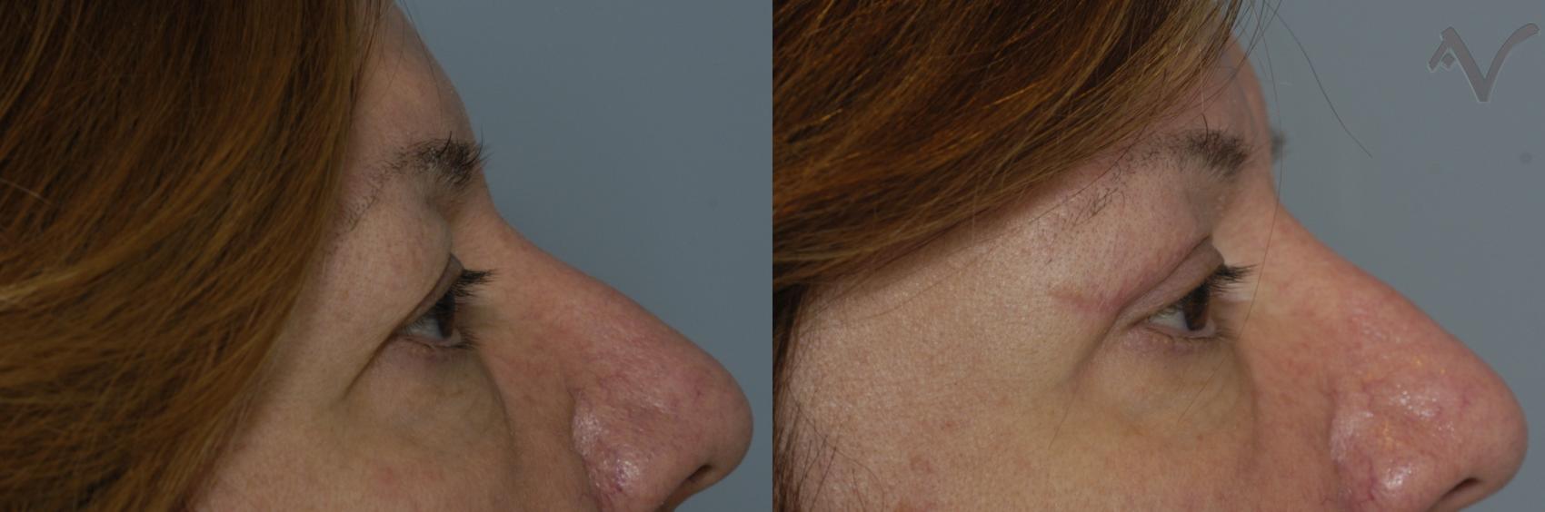 Before & After Upper Eyelid Surgery Case 316 Right Side View in Los Angeles, CA