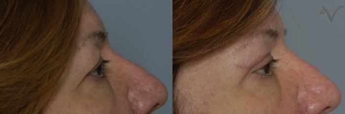 Before & After Upper Eyelid Surgery Case 316 Right Side View in Los Angeles, CA