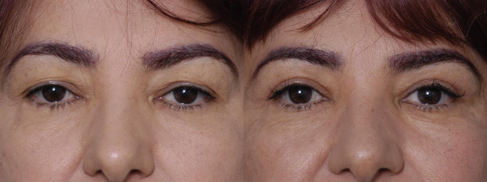 Before & After Upper Eyelid Surgery Case 318 Front View in Los Angeles, CA