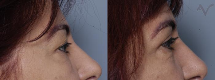 Before & After Upper Eyelid Surgery Case 318 Right Side View in Los Angeles, CA