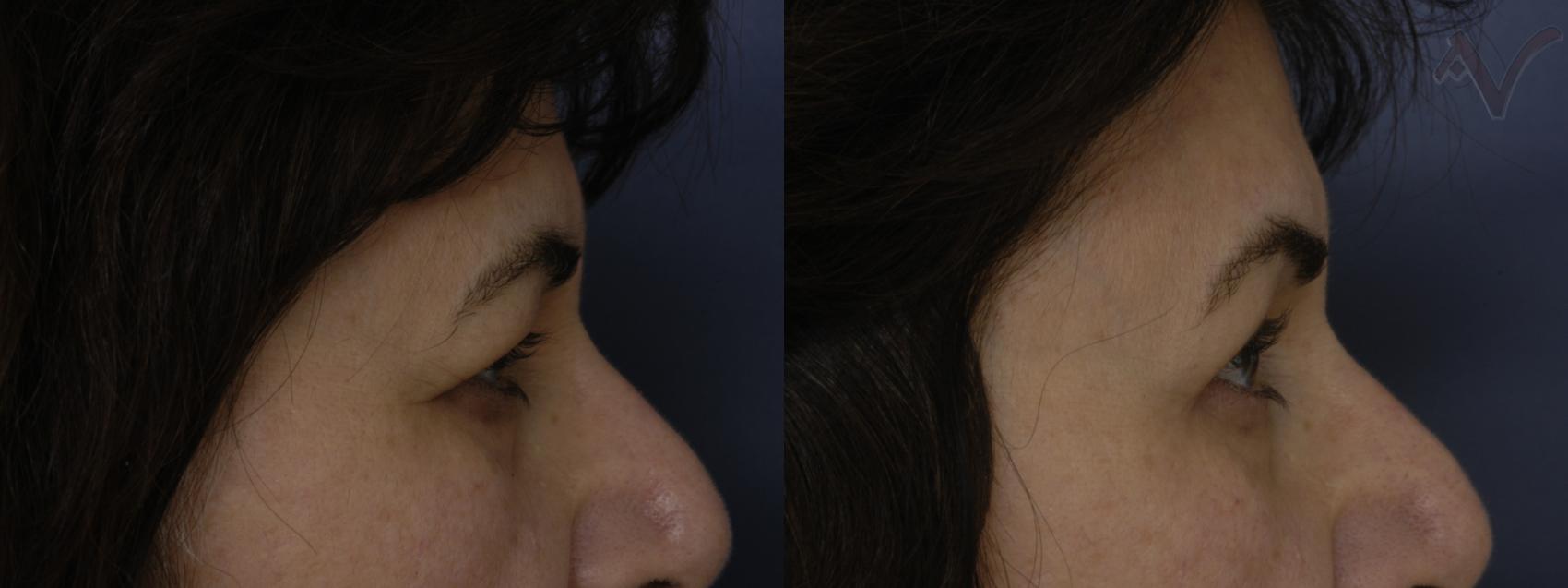 Before & After Upper Eyelid Surgery Case 319 Right Side View in Los Angeles, CA