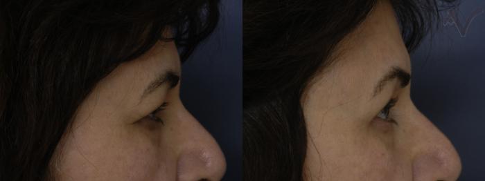 Before & After Upper Eyelid Surgery Case 319 Right Side View in Los Angeles, CA