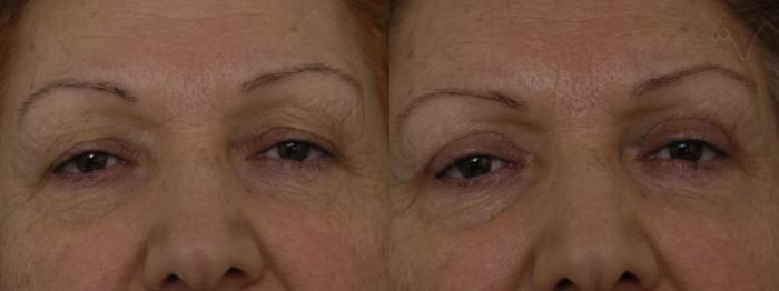 Before & After Upper Eyelid Surgery Case 320 Front View in Los Angeles, CA