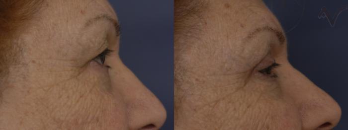 Before & After Upper Eyelid Surgery Case 320 Right Side View in Los Angeles, CA