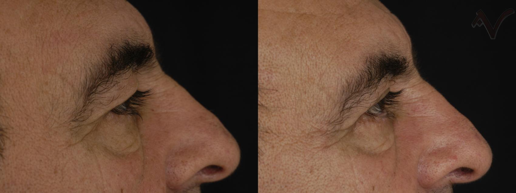 Before & After Upper Eyelid Surgery Case 321 Right Side View in Los Angeles, CA