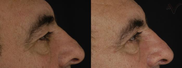 Before & After Upper Eyelid Surgery Case 321 Right Side View in Los Angeles, CA