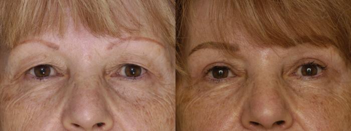 Before & After Upper Eyelid Surgery Case 347 Front View in Los Angeles, CA