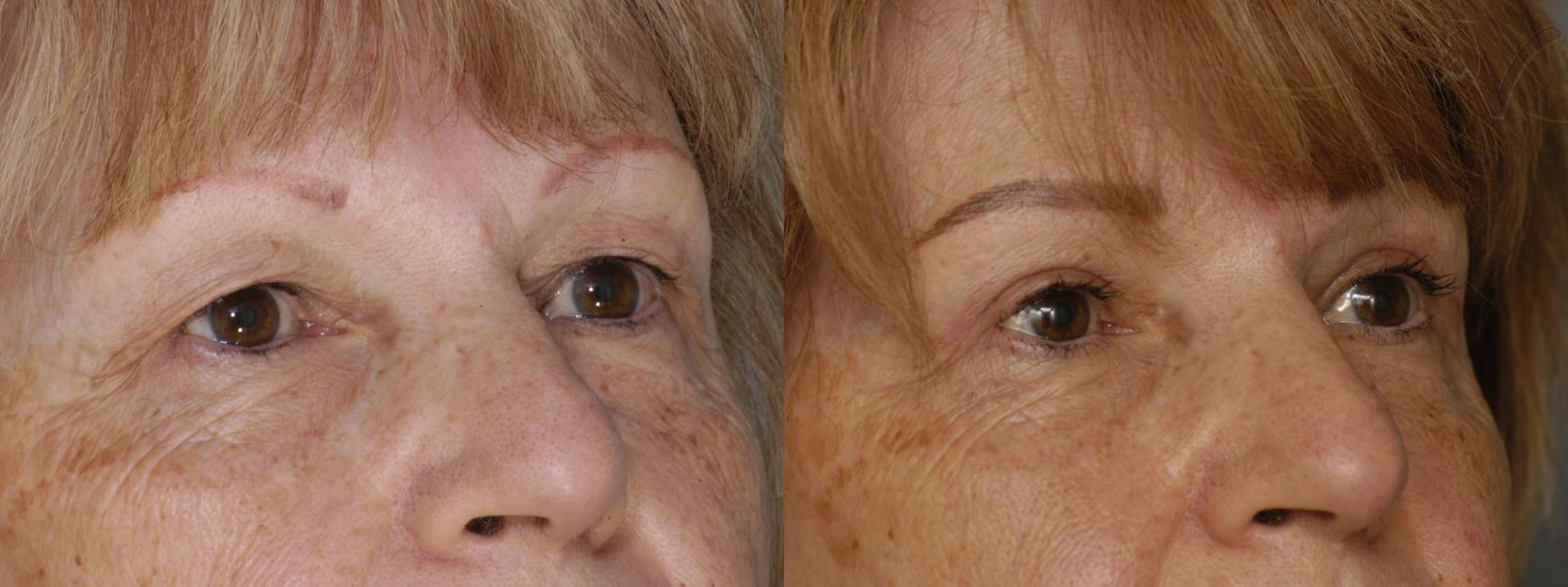 Before & After Upper Eyelid Surgery Case 347 Right Oblique View in Los Angeles, CA