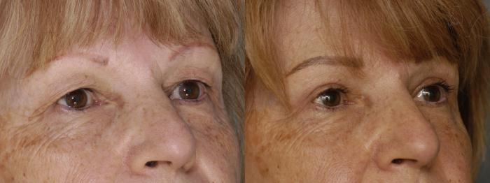 Before & After Upper Eyelid Surgery Case 347 Right Oblique View in Los Angeles, CA