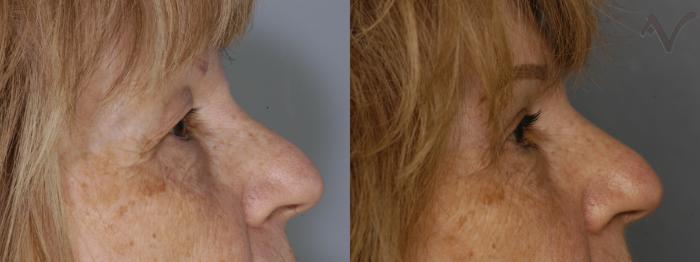 Before & After Upper Eyelid Surgery Case 347 Right Side View in Los Angeles, CA