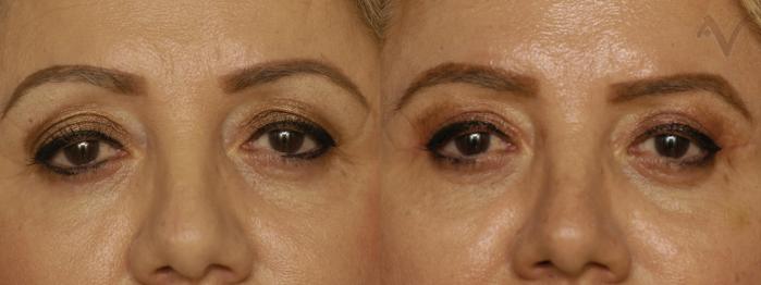 Before & After Upper Eyelid Surgery Case 348 Front View in Los Angeles, CA