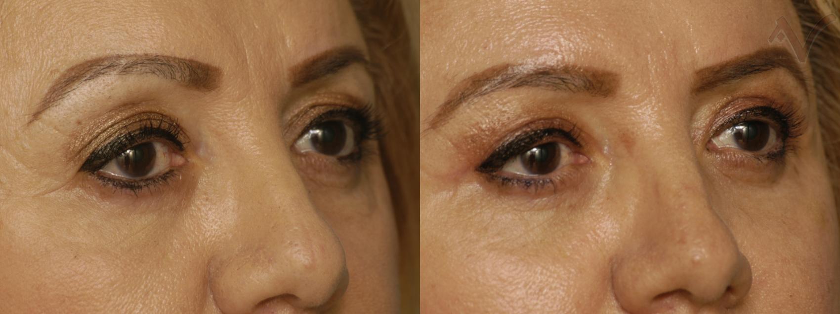 Before & After Upper Eyelid Surgery Case 348 Right Oblique View in Los Angeles, CA