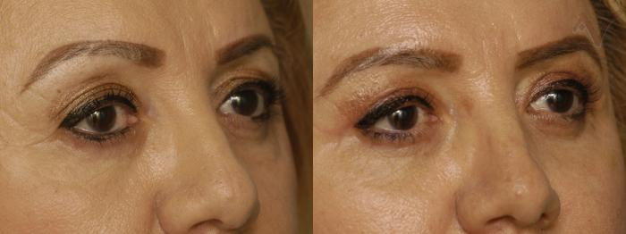 Before & After Upper Eyelid Surgery Case 348 Right Oblique View in Los Angeles, CA