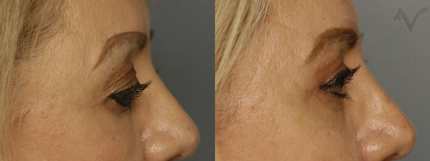 Before & After Upper Eyelid Surgery Case 348 Right Side View in Los Angeles, CA