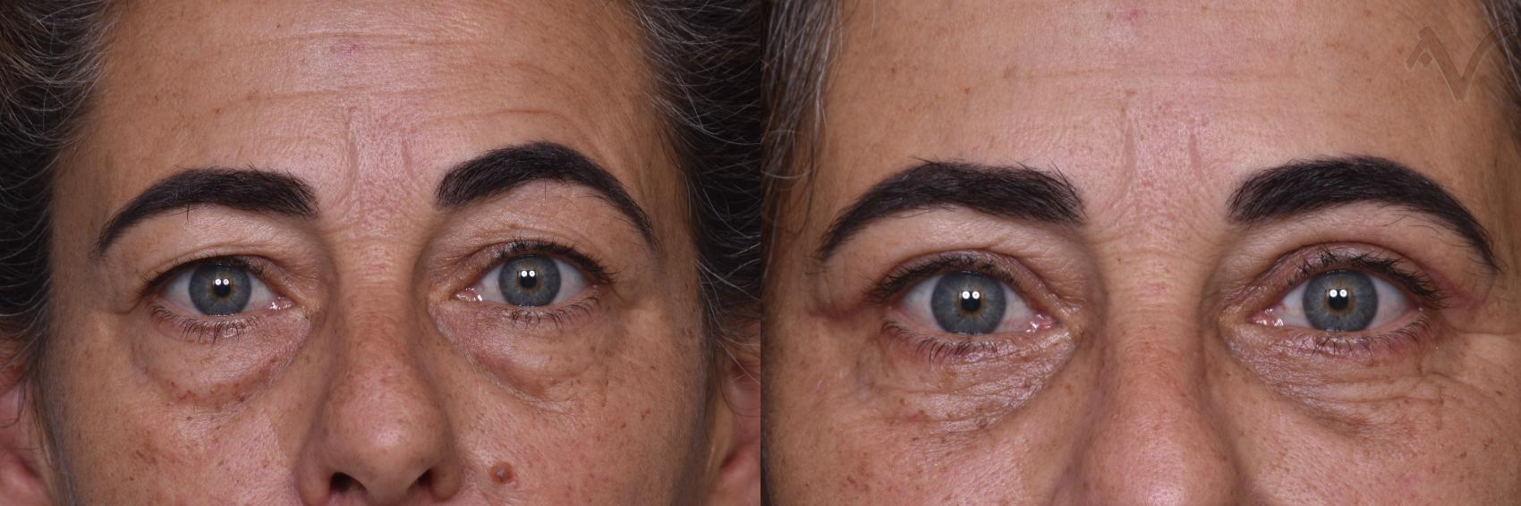 Before & After Upper Eyelid Surgery Case 375 Front View in Los Angeles, CA