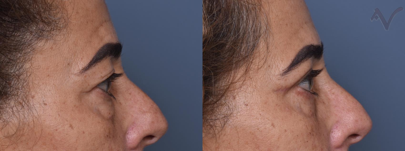 Before & After Upper Eyelid Surgery Case 375 Right Side View in Los Angeles, CA